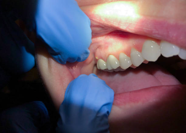 Best Broken or Chipped Tooth Repair in Cloverleaf, TX